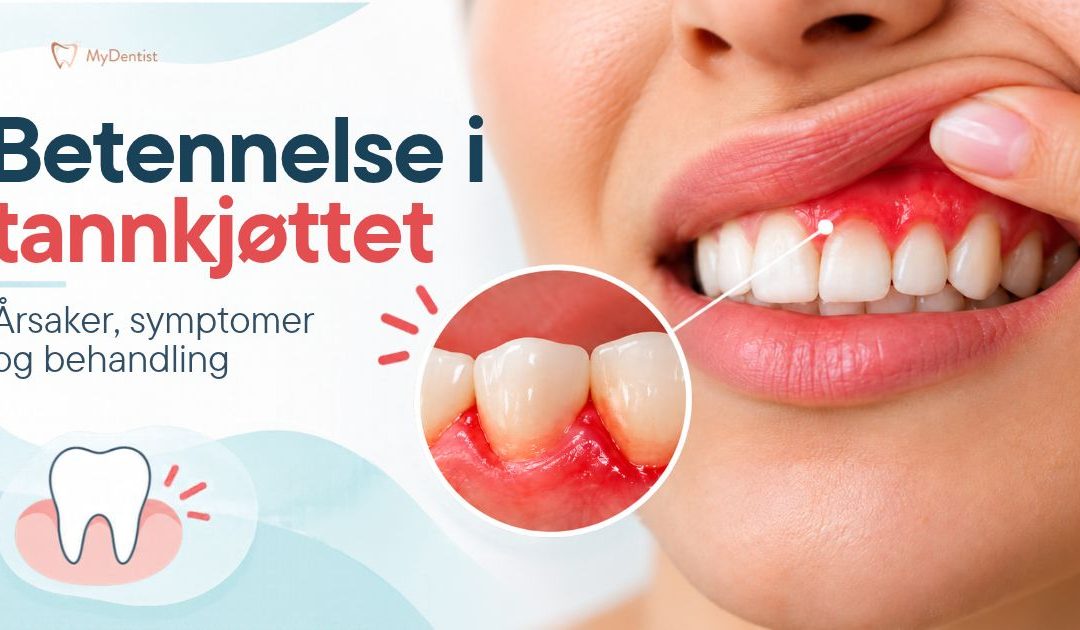 Betennelse i tannkjøttet med rødt og hovent tannkjøtt som viser vanlige symptomer på gingivitt.